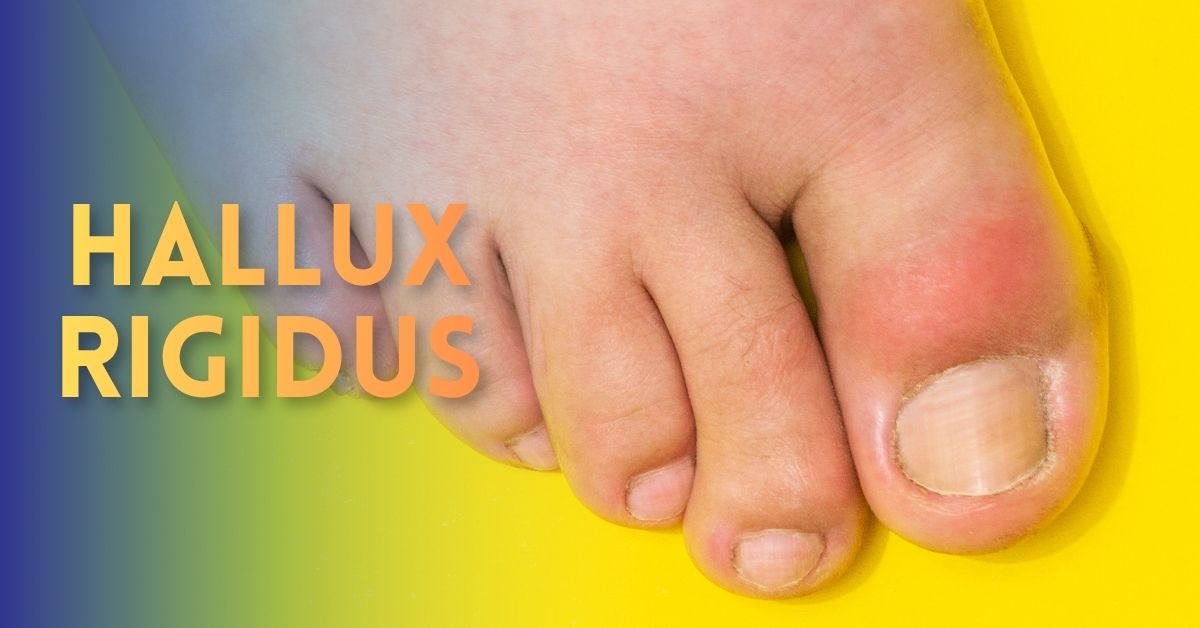 hallux rigidus